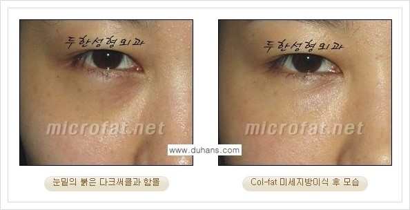 [두한성형외과 경쟁력 눈밑성형] - [눈밑 다크써클과 눈밑 함몰주름의 최적화 교정방법 안내] 관련 이미지 23