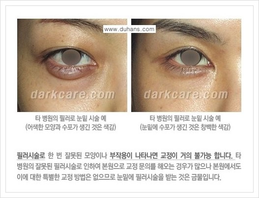 [두한성형외과 경쟁력 눈밑 다크써클 치료] - [다크써클 치료 실패의 원인 분석 안내] 관련 이미지 6