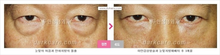 [두한성형외과 경쟁력 눈밑성형] - [눈밑 지방재배치의 문제점 안내] 관련 이미지 9