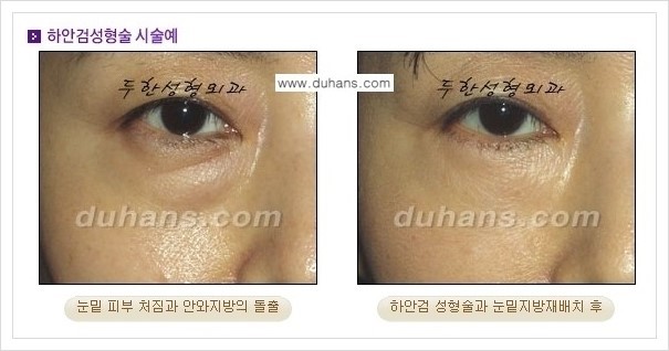 [두한성형외과 경쟁력 눈성형] - [젊은 눈매로의 복원 안검성형] 관련 이미지 21