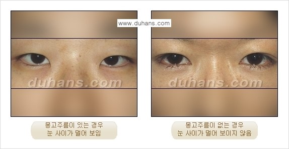 [두한성형외과 NO.1 눈성형] - [몽고주름 제거(앞트임 수술) 1.] 관련 이미지 2
