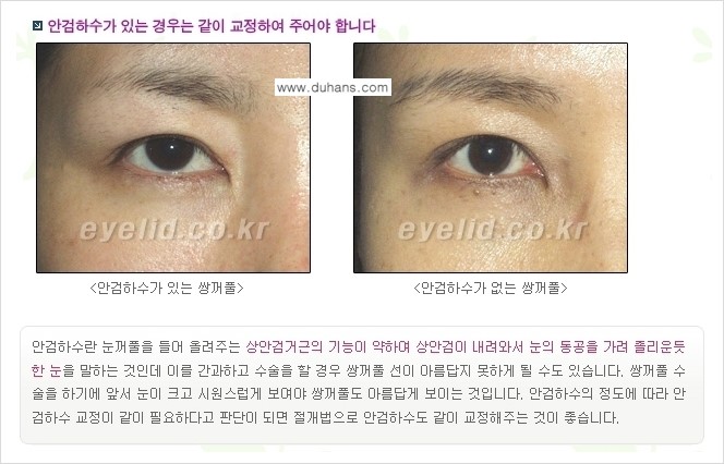 [두한성형외과 경쟁력 눈성형] - [퀵쌍꺼풀(부분절개법) 수술 안내] 관련 이미지 6