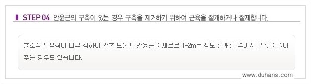[두한성형외과 경쟁력 쌍꺼풀 재수술, 극한 재수술] - [쌍꺼풀 재수술의 과정 안내 1.] 관련 이미지 4
