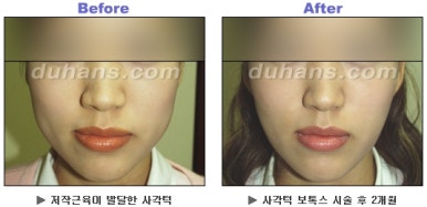 [Duhan Plastic Surgery Clinic Aesthetic Procedures] - [Square Jaw Botox] image 21
