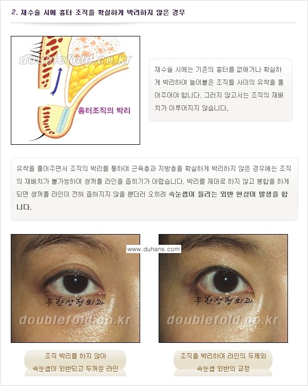 [두한성형외과 경쟁력 쌍꺼풀 재수술, 극한 눈재수술] - [쌍꺼풀 재수술, 눈 재수술의 실패 원인] 관련 이미지 2