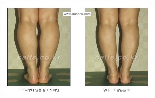 [두한성형외과 경쟁력 멀티종아리성형] - [정교한 미세흡입관 종아리 지방흡입술] 관련 이미지 9