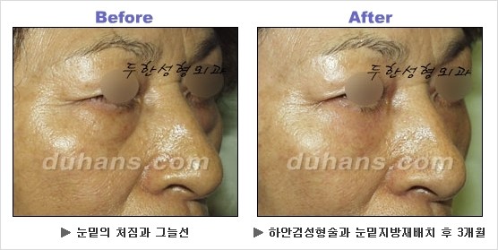 [두한성형외과 경쟁력 동안성형 리더] - ​[미간주름, 이마주름, 안검성형, 이마거상술, 눈썹거상술] 관련 이미지 96