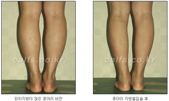 두한성형외과 지방흡입 - 부위별 안전 지방흡입 관련 이미지 35