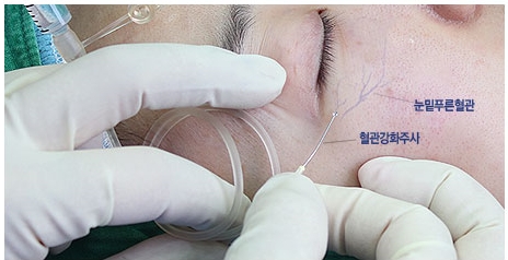 두한성형외과 보기싫은 혈관제거 - 눈밑혈관, 손과 팔의 혈관확장증 치료 관련 이미지 4
