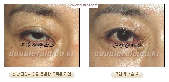 [두한성형외과 경쟁력 눈성형] - [극한 재수술, 함몰된 눈꺼풀 라인교정, 안검하수(졸리운 눈매)] 관련 이미지 6