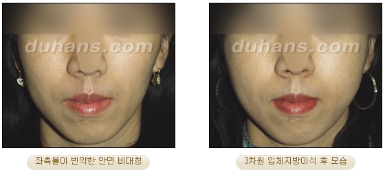 [두한성형외과 얼굴자가지방이식] - [볼살, 이마, 측두부] 관련 이미지 27