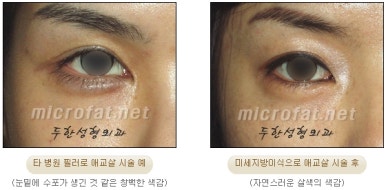 두한성형외과 눈밑성형 - 애교필러 후 눈밑재수술 관련 이미지 3