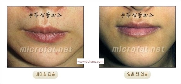 ​​​[두한성형외과 경쟁력 지방이식] - [지방이식을 이용한 입술성형 안내] 관련 이미지 3