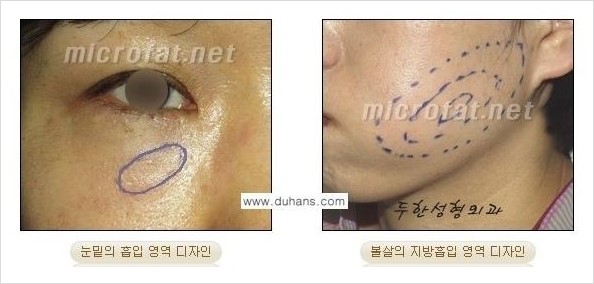 ​[두한성형외과 경쟁력 지방이식] - [지방이식 부작용 이후 마이크로 지방흡입, 마이크로 지방흡입 이후 부작용 없는 지방이식 방법] 관련 이미지 1
