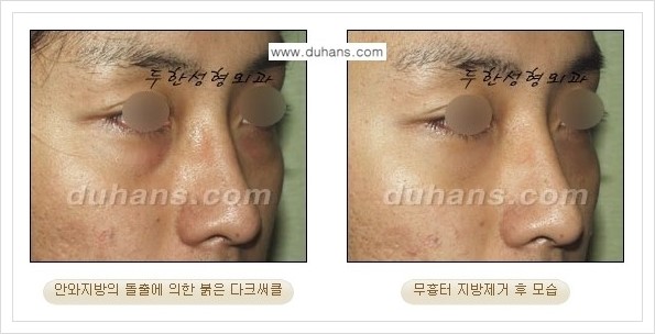 [두한성형외과 경쟁력 안검성형] - [눈밑 지방제거 안내] 관련 이미지 21