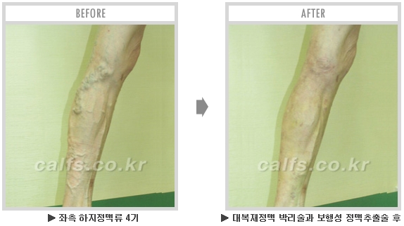[종아리성형 두한성형외과] - [종아리수술에 대한 자주하는 질문과 답변 모음] 관련 이미지 11