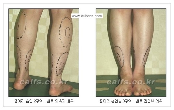 [두한성형외과 경쟁력 멀티종아리성형] - [두꺼운 종아리 정교한 미세흡입관 지방흡입술] 관련 이미지 3