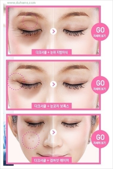 [두한성형외과 경쟁력 눈밑성형] - [다크써클의 원인과 종류, 다크써클의 치료 방법] 관련 이미지 45