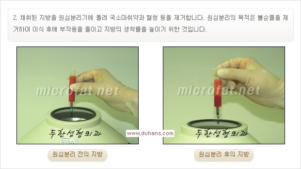 [두한성형외과 경쟁력 미세지방이식] - [부드럽고 아름다운 얼굴윤곽선 턱(하악부) 미세지방이식 안내] 관련 이미지 9