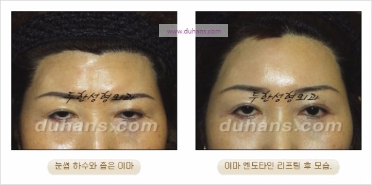 [두한성형외과 주름성형] - [주름교정술 - 강력한 리프팅 파워 엔도타인 리프팅 ] 관련 이미지 28