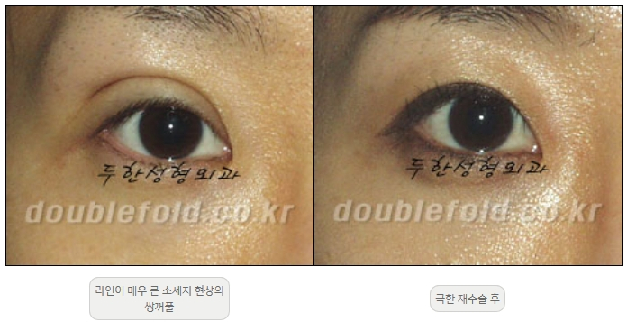 [Duhan Plastic Surgery Double Eyelid Revision] - [Thick Double Eyelid Line] image 50