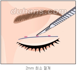 쌍커풀수술 두한성형외과 - 나에게 맞는 눈성형은? 관련 이미지 20