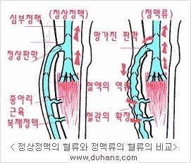 [두한성형외과 경쟁력 정맥류 치료] - [정맥류의 원인과 문제점, 정맥류 진단 방법] 관련 이미지 6