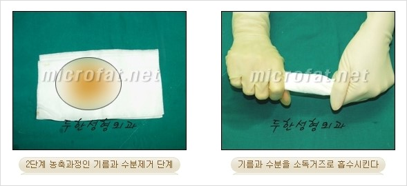 ​[두한성형외과 경쟁력 지방이식] - [지방이식 부작용 이후 마이크로 지방흡입, 마이크로 지방흡입 이후 부작용 없는 지방이식 방법] 관련 이미지 14