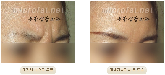[두한성형외과 자가지방이식] - [미간주름] 관련 이미지 20