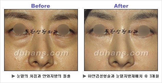 [두한성형외과 경쟁력 동안성형 리더] - ​[미간주름, 이마주름, 안검성형, 이마거상술, 눈썹거상술] 관련 이미지 81