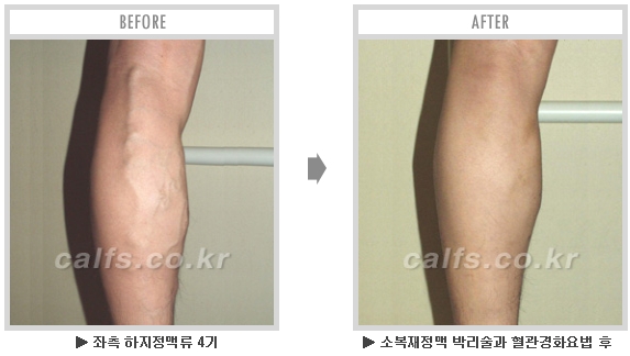 [종아리성형 두한성형외과] - [종아리수술에 대한 자주하는 질문과 답변 모음] 관련 이미지 4