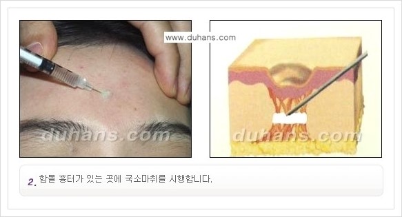 [두한성형외과 경쟁력 함몰 흉터 교정] - [동시에 3가지 시술로 효과적인 함몰 흉터 교정 안내] 관련 이미지 5