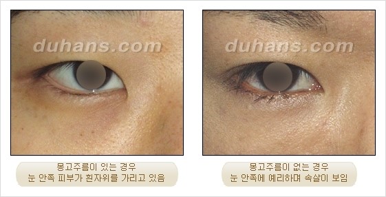 [DuHan Plastic Surgery Eye Surgery] - [Guide to Epicanthoplasty and Canthoplasty for Increasing the Horizontal Width of the Eyes] image 9