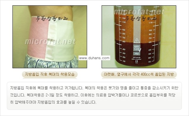 [두한성형외과 간편 지방흡입] - [복부지방흡입 안내 2.] 관련 이미지 9