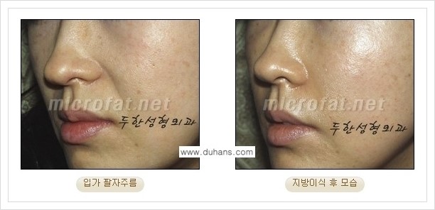 [두한성형외과 경쟁력 미세지방이식] - [입가주름, 팔자주름 교정 안내] 관련 이미지 7