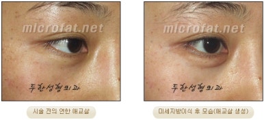 두한성형외과 눈밑성형 - 애교필러 후 눈밑재수술 관련 이미지 45