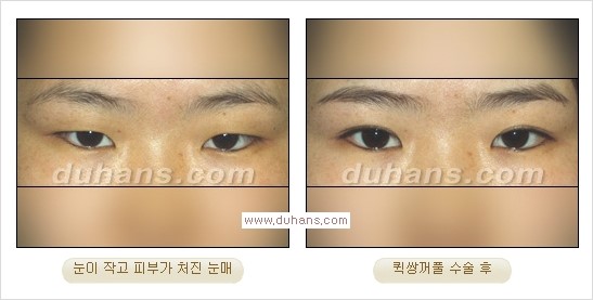 ​[두한성형외과 경쟁력 눈성형] - [자연스럽고 아름다운 쌍꺼풀의 기준] 관련 이미지 17