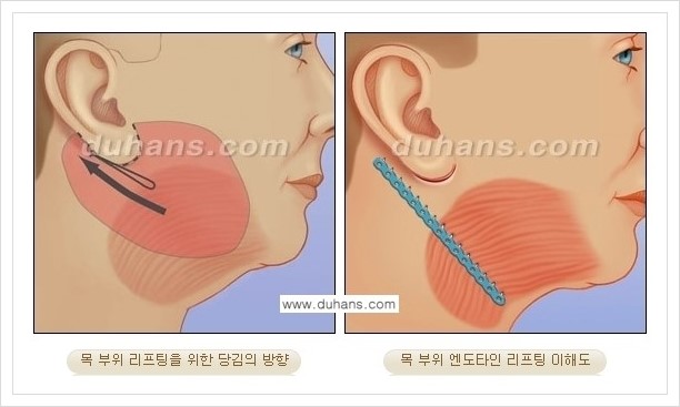 [두한성형외과 경쟁력 주름성형] - [주름제거 방법 안내] 관련 이미지 7
