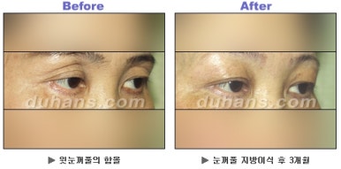 [Duhan Plastic Surgery Blepharoplasty] - [Upper Eyelid Surgery for a Younger-Looking Eye Area] image 7