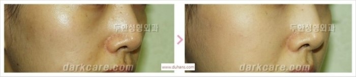 [두한성형외과 경쟁력 멀티성형] - [다크써클과 인디언밴드와의 관계] 관련 이미지 9