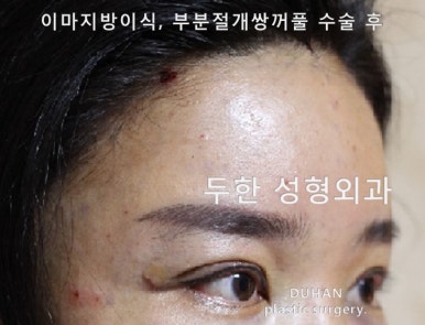 [Duhan Plastic Surgery Eye Surgery] - [Quick Double Eyelid Surgery] image 28