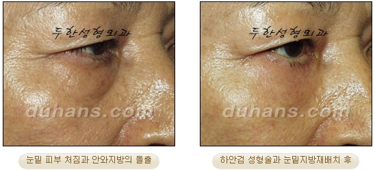 [Duhan Plastic Surgery Ophthalmic Plastic Surgery] - [Lower Blepharoplasty] image 17