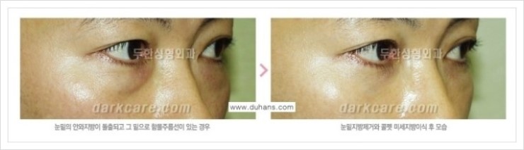 [두한성형외과 경쟁력 눈밑성형] - [눈밑 다크써클 증상과 그 증상에 맞는 치료 방법 안내] 관련 이미지 10