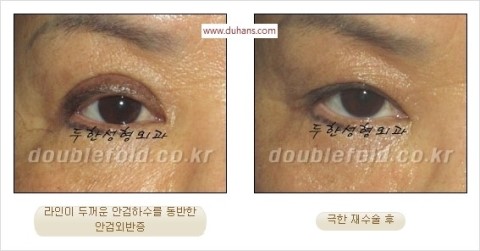 ​[두한성형외과 눈재수술] - [앞트임복원, 뒤트임복원, 쌍꺼풀복원] 관련 이미지 27