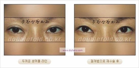 [두한성형외과 경쟁력 눈성형] - [쌍꺼풀 재수술에 대한 최선의 대안 제시] 관련 이미지 15