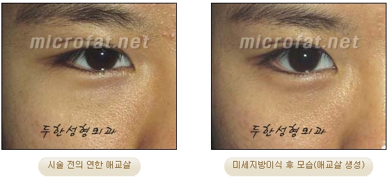 Duhan Plastic Surgery Under-Eye Surgery - Correction with Fat Grafting After Aegyo-Sal Filler image 17