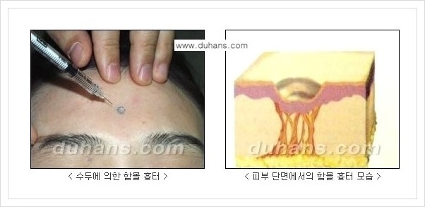 [두한성형외과 경쟁력 함몰흉터교정] - [함몰흉터의 DHC 시술 안내] 관련 이미지 1