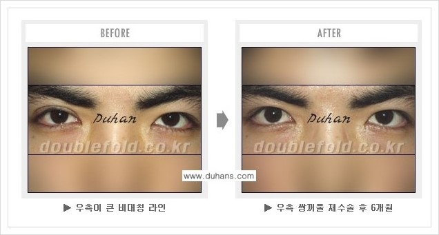[두한성형외과 경쟁력 쌍꺼풀 재수술(극한 재수술)] - [피부 여유분이 부족해서 토안증이 발생한 경우의 문제점 해결 안내] 관련 이미지 4