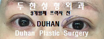 [DuHan Plastic Surgery Double Eyelid Surgery] - [Frequently Asked Questions and Answers About Eye Plastic Surgery] image 16