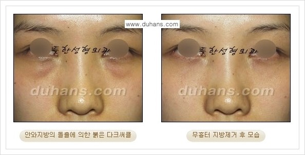 [두한성형외과 경쟁력 안검성형] - [눈밑 지방제거 안내] 관련 이미지 17